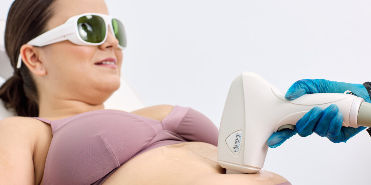 Tratamento para a hipertricose: depilação a laser díodo