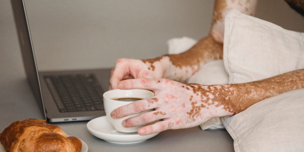 depilação a laser e vitiligo