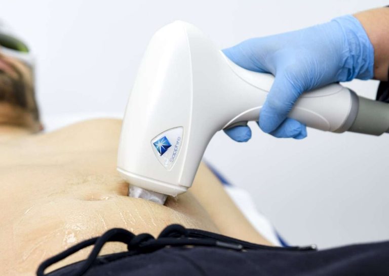 Depilação a laser masculina na linha alba