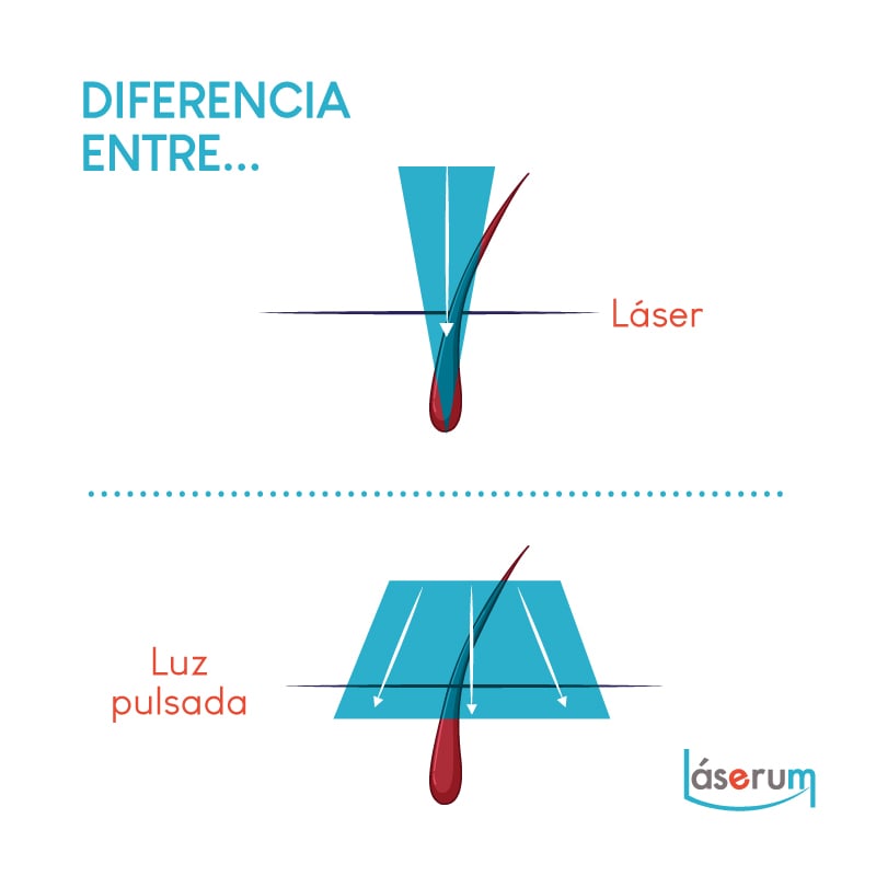fotodepilação ou laser diodo