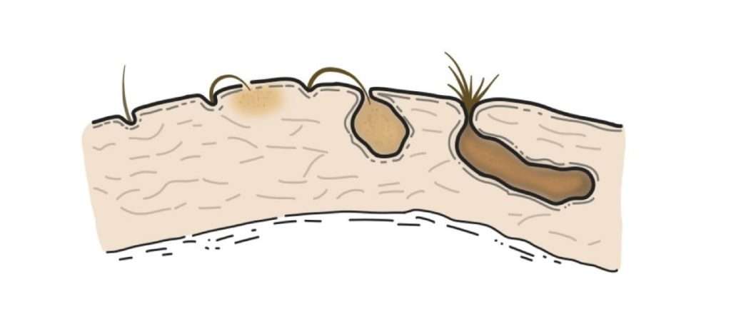como o sinus pilonidalis se forma